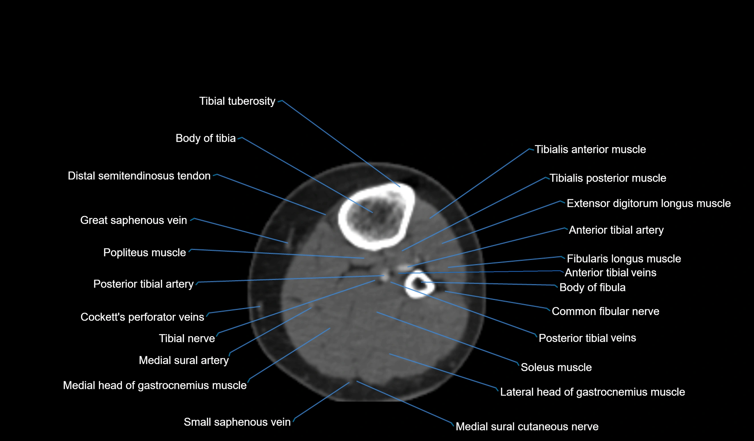 CT knee axial cross sectional anatomy labelled image-00055.webp